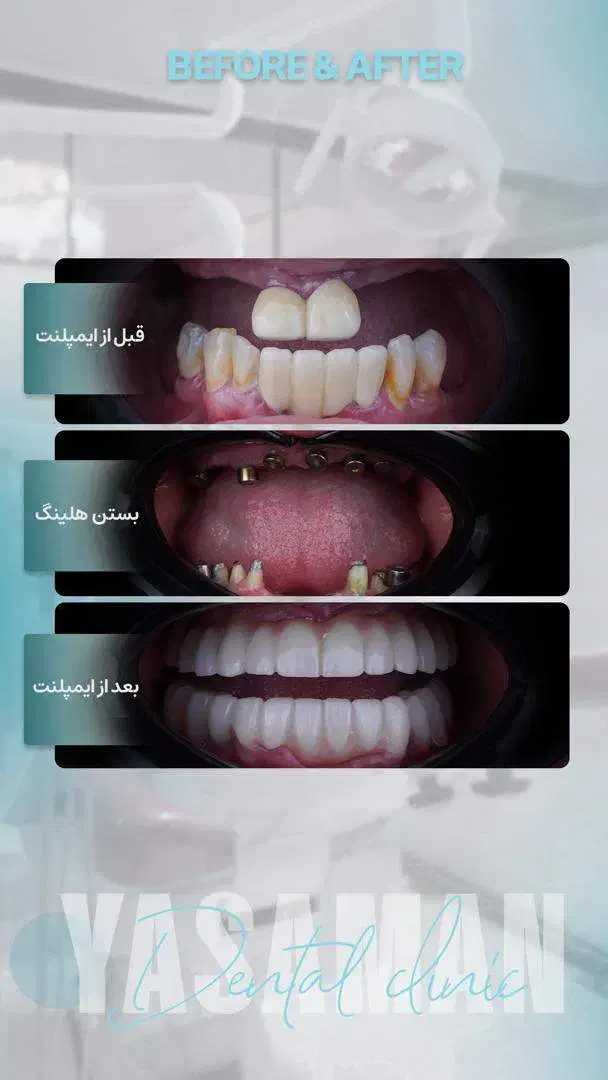 ایمپلنت تخصصی/لمینت/لیفت لثه/کامپوزیت|خدمات آرایشگری و زیبایی|مشهد, سجاد شهر|دیوار