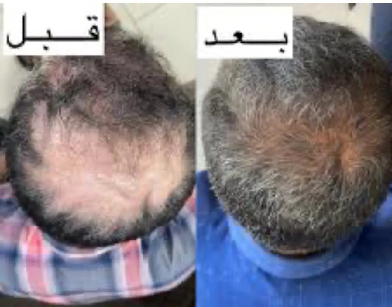 PRGF|خدمات آرایشگری و زیبایی|مشهد, فردوسی|دیوار