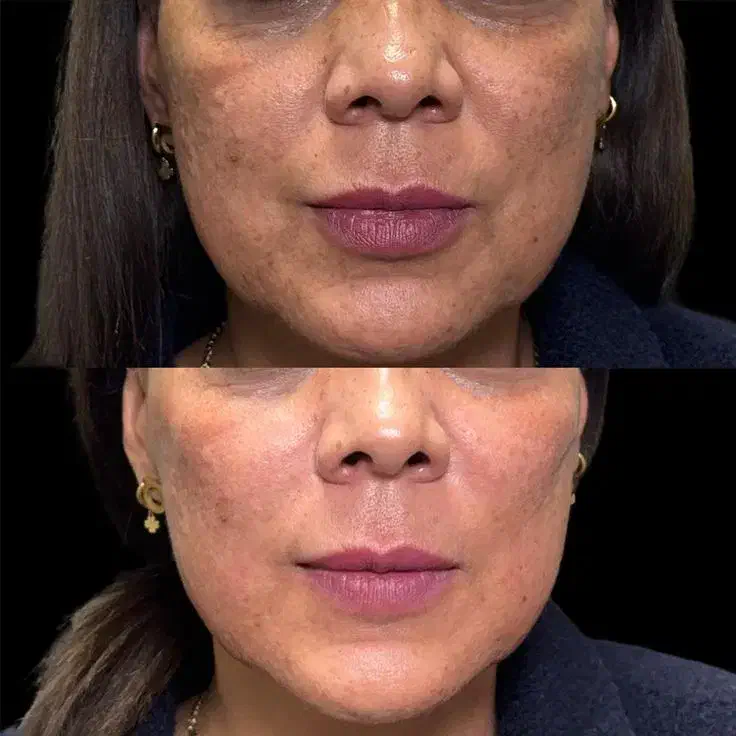 تزریق چربی جوانساز|خدمات آرایشگری و زیبایی|رفسنجان, |دیوار