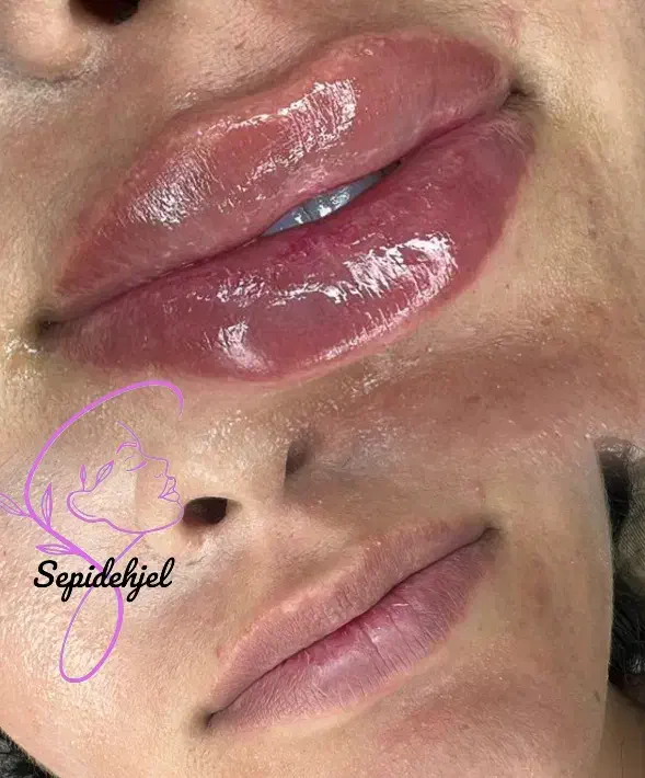 ژل و بوتاکس مزو و انزیم، سیار هستم...|خدمات آرایشگری و زیبایی|قرچک, شهرک طلائیه|دیوار