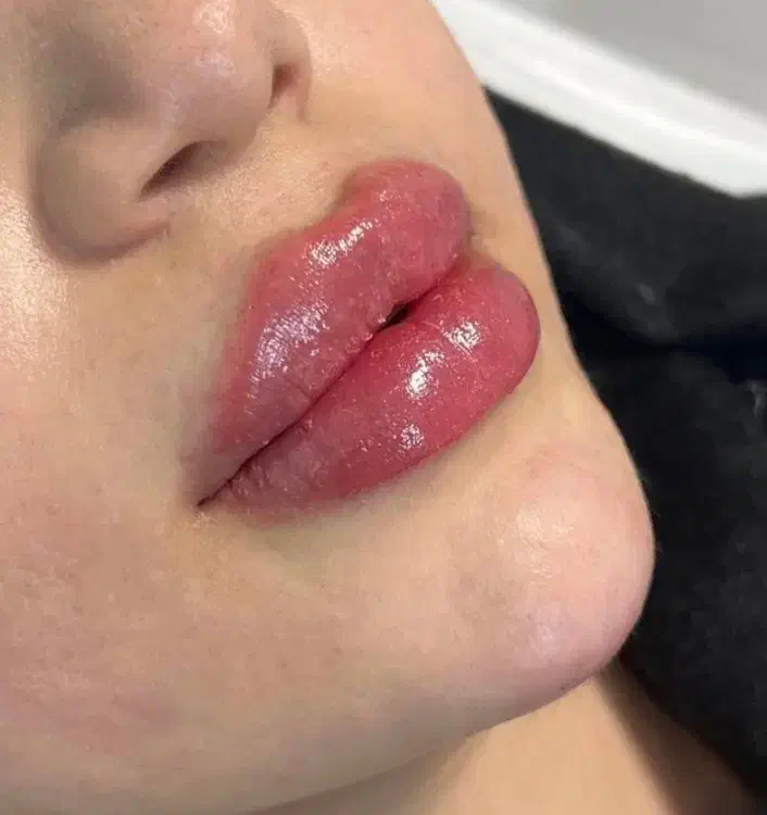 تزریق ژل و بوتاکس بدون درد و کبودی|خدمات آرایشگری و زیبایی|بروجن, |دیوار