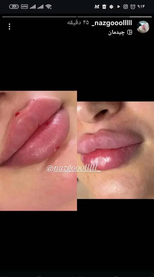 خدمات ژل و بوتاکس|خدمات آرایشگری و زیبایی|بهبهان, |دیوار