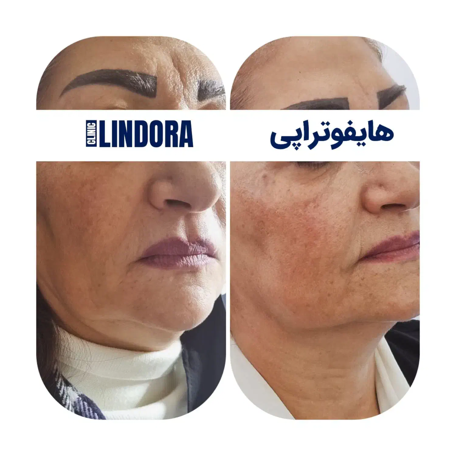 جشنواره عیدانه کلینیک زیبایی لیندورا|خدمات آرایشگری و زیبایی|تهران, درختی|دیوار