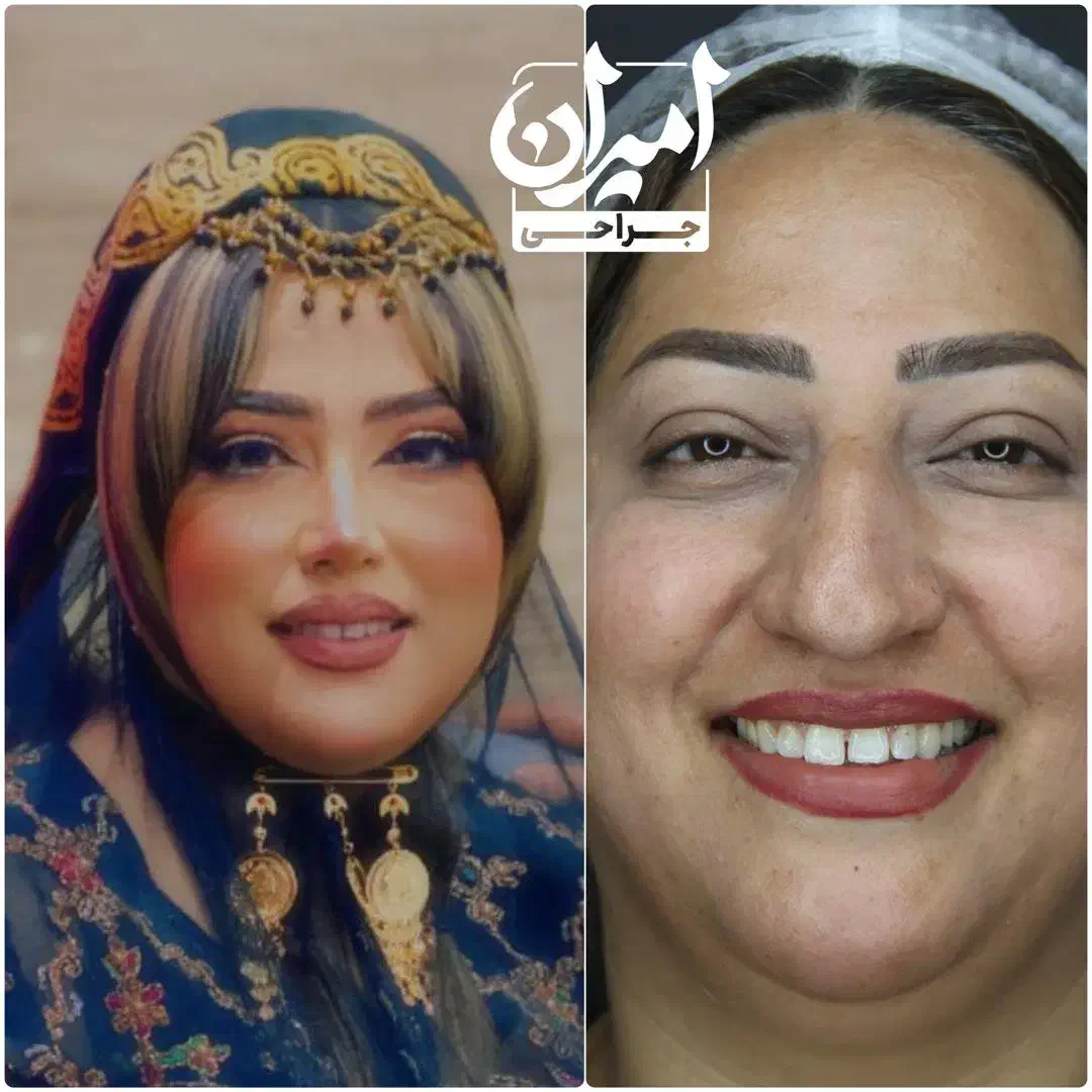 عمل بینی/ جراحی بینی|خدمات آرایشگری و زیبایی|شیراز, تاچارا|دیوار