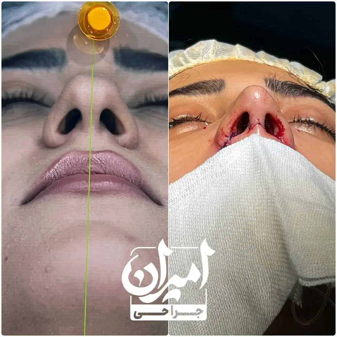 عمل بینی/ جراحی بینی|خدمات آرایشگری و زیبایی|شیراز, تاچارا|دیوار