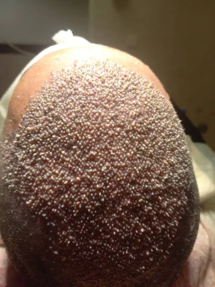 کاشت مو فول تراکم شیرازی|خدمات آرایشگری و زیبایی|نهاوند, |دیوار