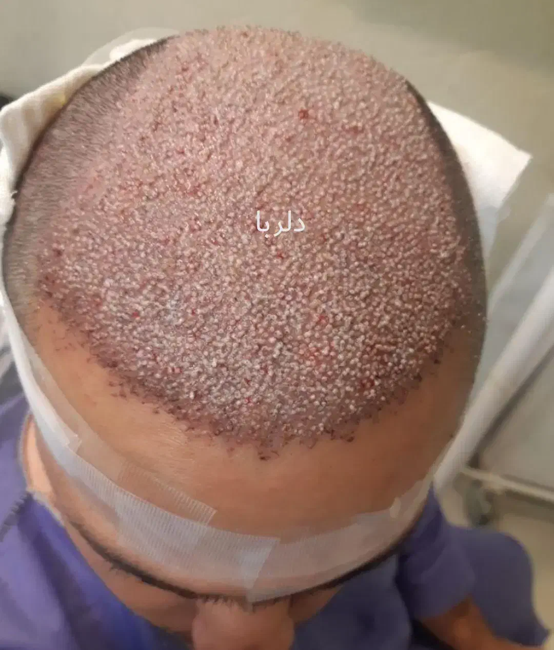 کاشت مو تخصصی دلربا|خدمات آرایشگری و زیبایی|حمیدیه, |دیوار