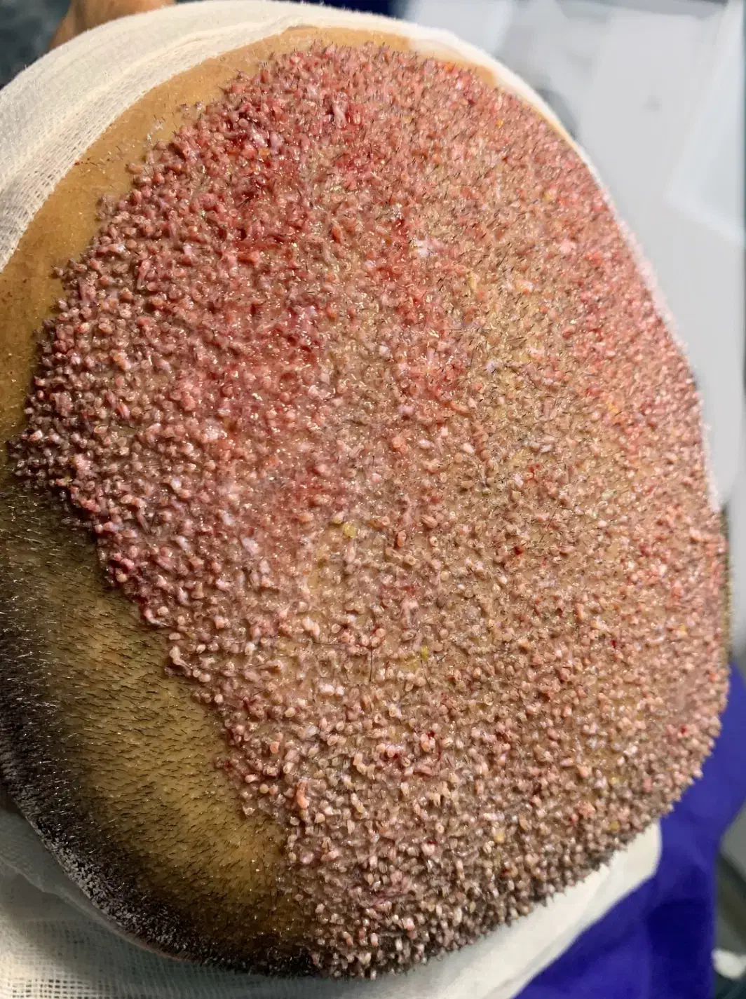 کاشت مو اقساطی بدون سود|خدمات آرایشگری و زیبایی|مشهد, هنرستان|دیوار