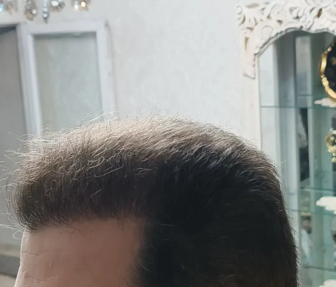 کاشت مو باضمانتنامه کتبی مادام العمر|خدمات آرایشگری و زیبایی|تبریز, |دیوار