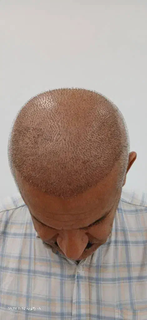 کاشت مو طبیعی در بوشهر وشیراز|خدمات آرایشگری و زیبایی|بوشهر, |دیوار