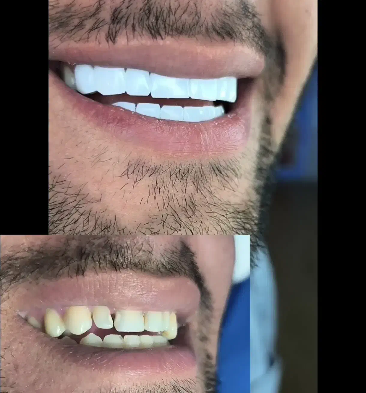 کامپوزیت دندان|خدمات آرایشگری و زیبایی|دورود, |دیوار