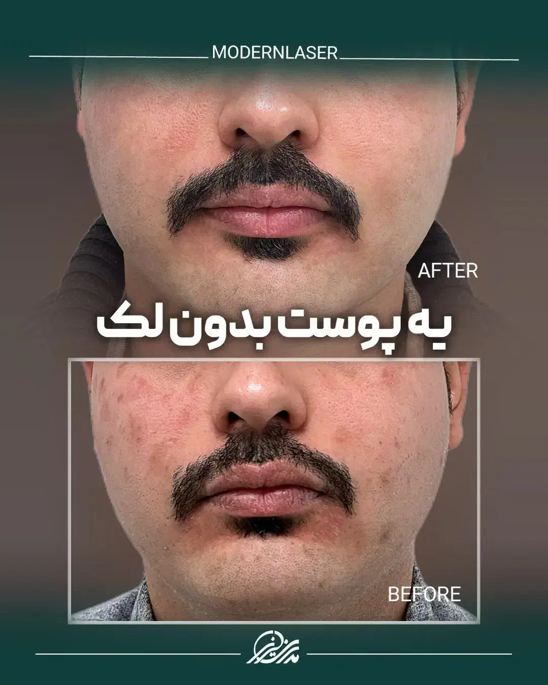 درمان کامل انواع لک پوستی توسط پزشک|خدمات آرایشگری و زیبایی|اصفهان, سعادتآباد|دیوار