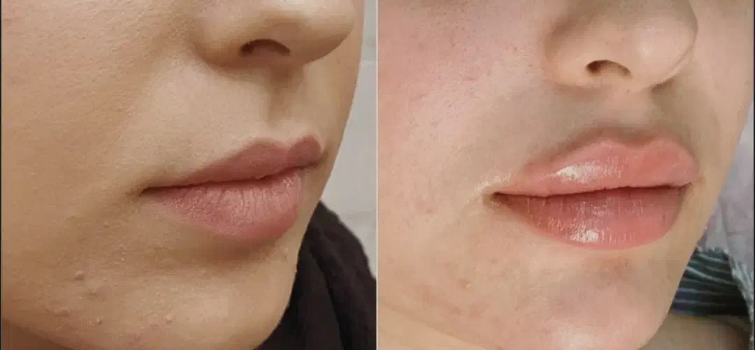 تزریق فیلر و بوتاکس توسط پزشک در کلینیک زیبایی|خدمات آرایشگری و زیبایی|قم, نیروگاه|دیوار