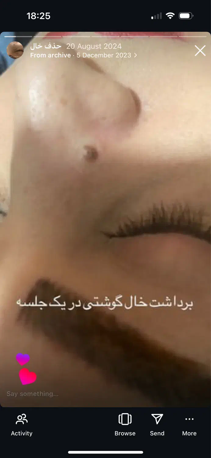 پاکسازی پوست دائمی|خدمات آرایشگری و زیبایی|قرچک, میرزائی جنوبی|دیوار