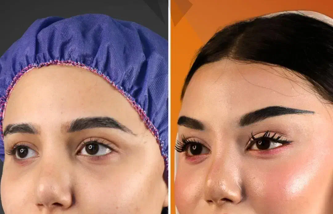 آف۲۰روز/۴۰٪لیفت شقیقه وجراح پلاستیک بدن/دستگاه پال|خدمات آرایشگری و زیبایی|مشهد, کوه سنگی|دیوار