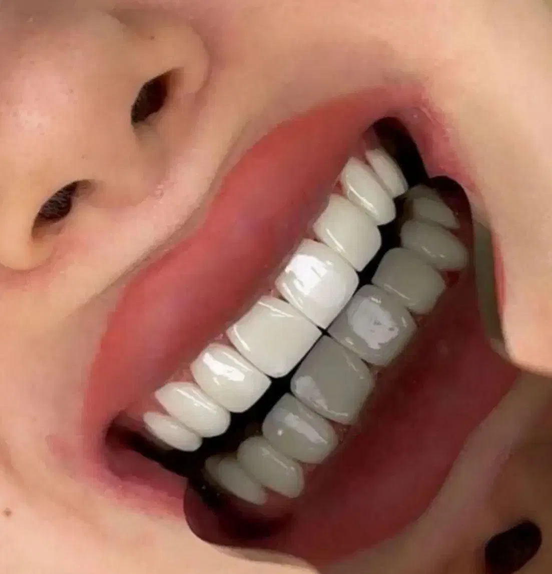 کامپوزیت دندان|خدمات آرایشگری و زیبایی|بوشهر, |دیوار