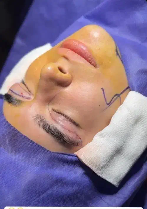 بلفاروپلاستی،لیفت ابرو،لیفت شقیقه،دایرکت ابرو|خدمات آرایشگری و زیبایی|ارومیه, |دیوار