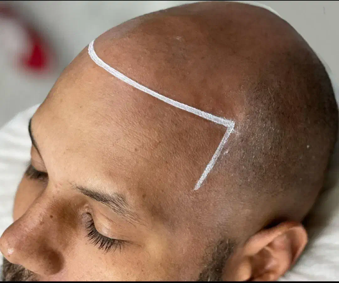 میکرو اسکالپ موی سر ،ریش، ابرو( در محل)|خدمات آرایشگری و زیبایی|تهران, سعادتآباد|دیوار