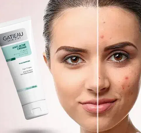 کرم ژل انتی اکنه گاتیو|آرایشی، بهداشتی، درمانی|نائین, |دیوار