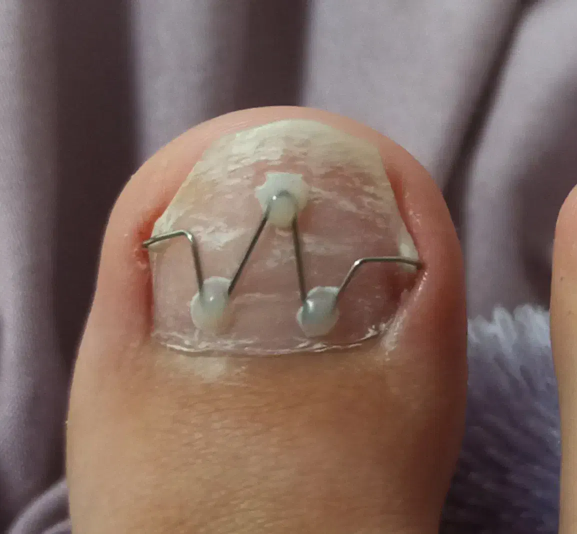 .پدولوژی ودرمان تخصصی عارضه های ناخن وپوست پا|خدمات آرایشگری و زیبایی|مرند, |دیوار