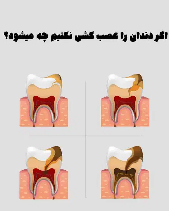 عصب کشی دندان کرسی پایین با هزینه کم|خدمات آرایشگری و زیبایی|بیرجند, |دیوار