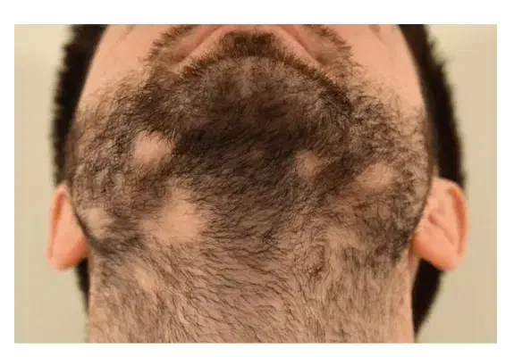 ریزش موی سکه ای|آرایشی، بهداشتی، درمانی|میناب, |دیوار