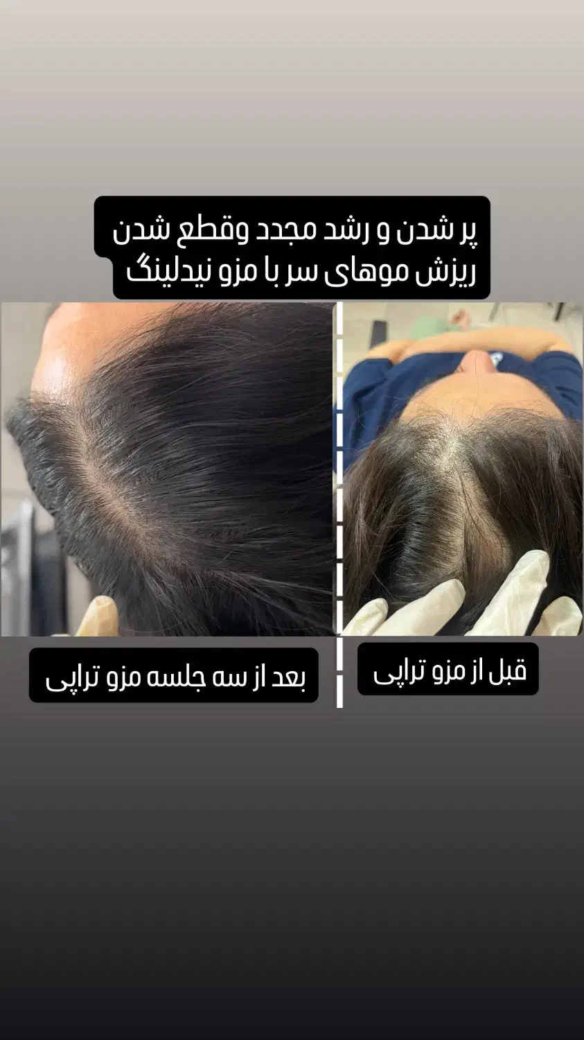 مزوتراپی و مزونیدلینگ مو درمان ریزش مو و رویش مجدد|خدمات آرایشگری و زیبایی|قائم‌شهر, |دیوار