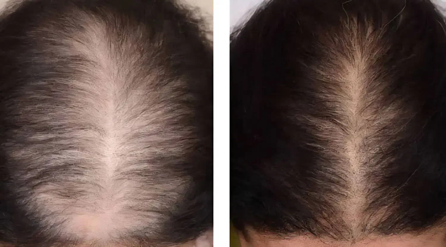 پی آر پی و مزوتراپی مو و ابرو|خدمات آرایشگری و زیبایی|اردبیل, |دیوار