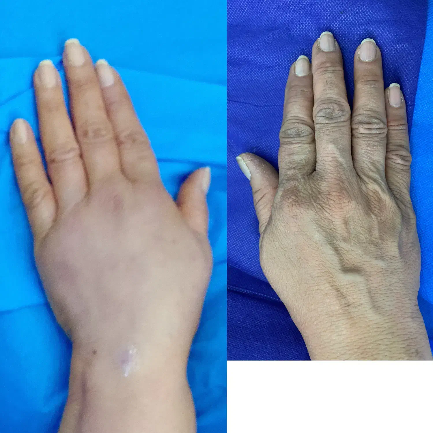 ساکشن غبغب و شکم فیلر بادی پی ار پی ژل و بوتاکس|خدمات آرایشگری و زیبایی|شیراز, قصرالدشت|دیوار