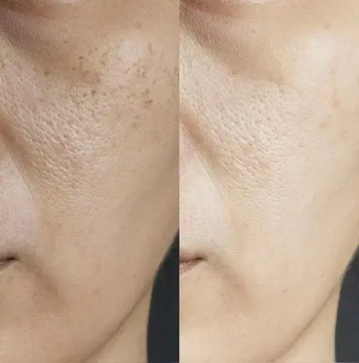 پاکسازی و جوانسازی پوست با تجهیزات پیشرفته|خدمات آرایشگری و زیبایی|رشت, گلسار|دیوار