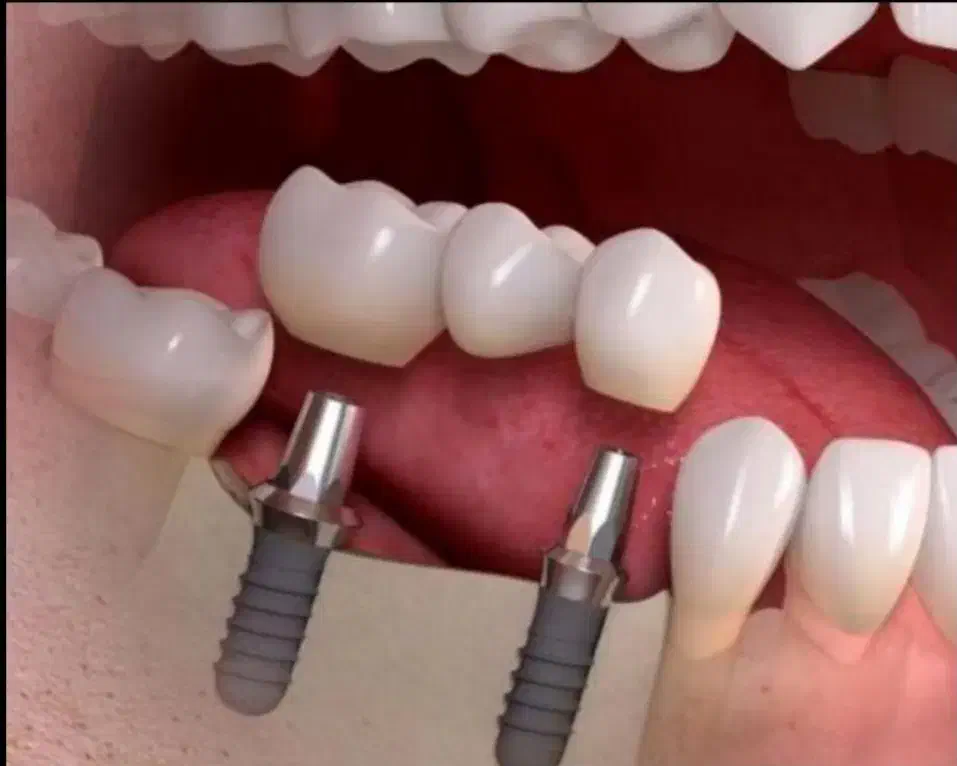 جشنواره ایمپلنت دیجیتال در شیراز|خدمات آرایشگری و زیبایی|جهرم, |دیوار