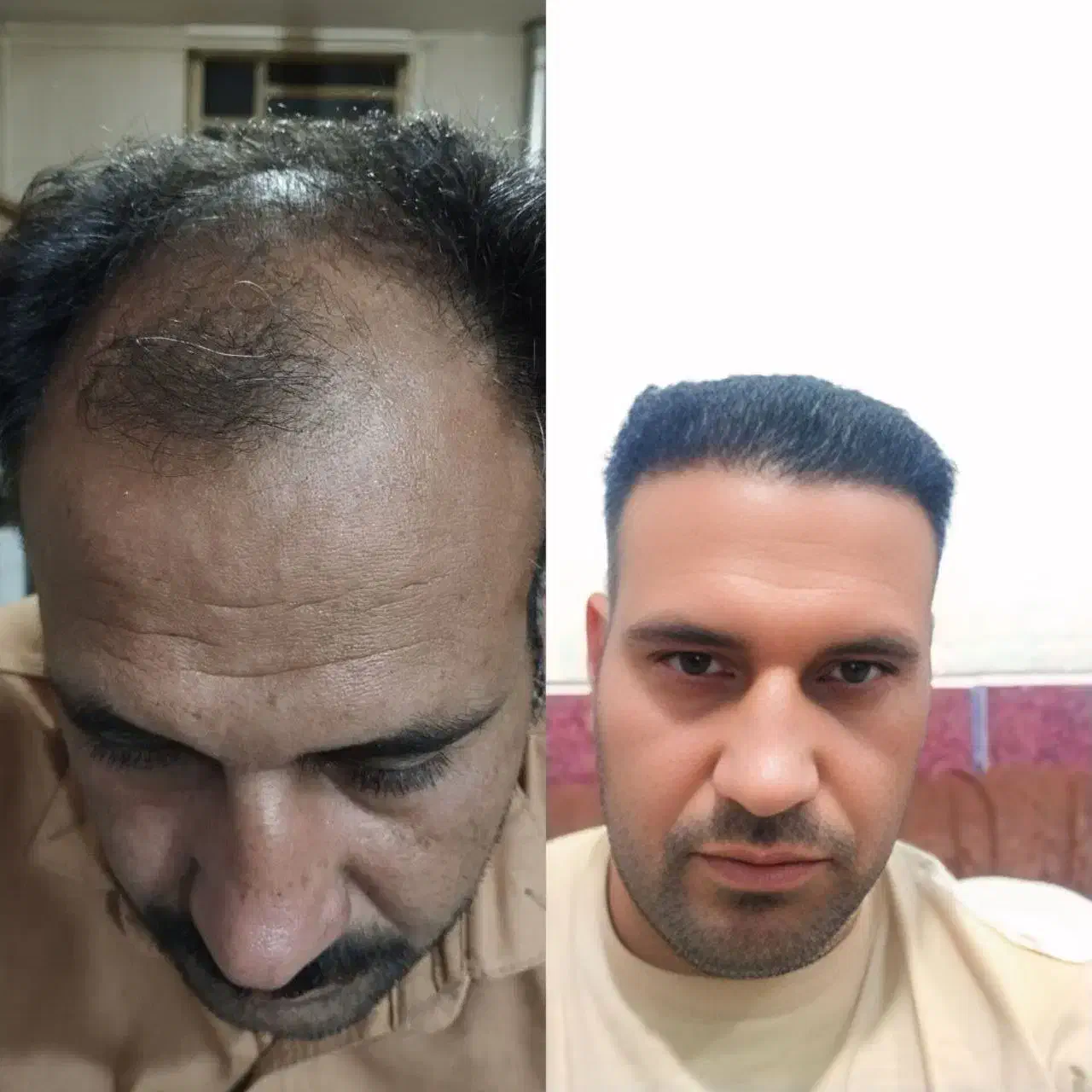 کاشت مو با خط رویش طبیعی و ضمانت نامه|خدمات آرایشگری و زیبایی|یاسوج, |دیوار