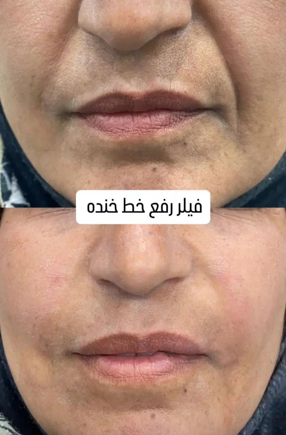 جشنواره آف ژل و بوتاکس|خدمات آرایشگری و زیبایی|شیراز, خلدبرین|دیوار