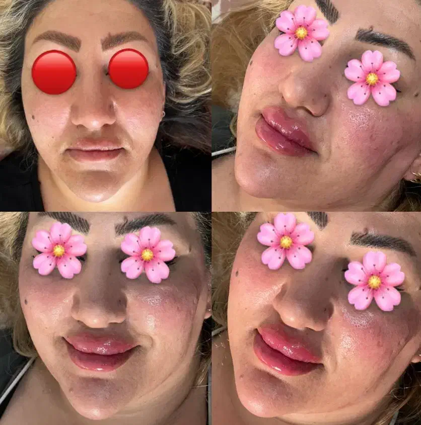 ژل بوتاکس پیرسینگ مزوژل آنزیم آموزش|خدمات آرایشگری و زیبایی|اسلام‌‌آباد غرب, |دیوار