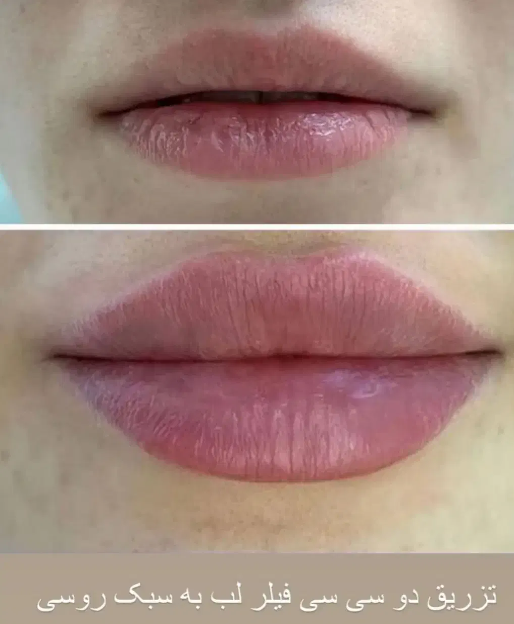 ژل .بوتاکس.انزیم،انواع پرسینگ با بهترین کیفیت.|خدمات آرایشگری و زیبایی|ملایر, |دیوار