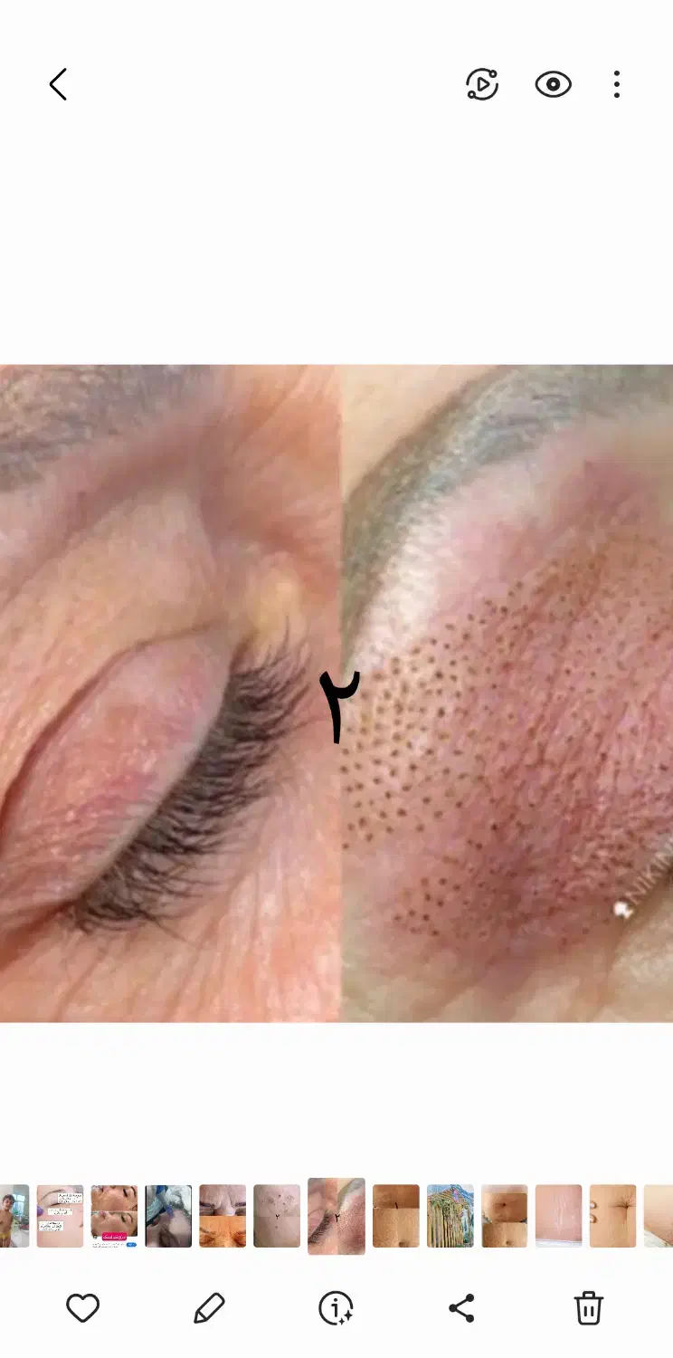 خدمات ریموو تتو صورت وجوانسازی صورت|خدمات آرایشگری و زیبایی|اصفهان, شهرک ولیعصر|دیوار