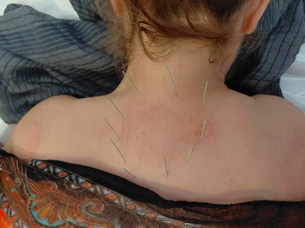 حجامت و بادکش گرم درمانی|خدمات آرایشگری و زیبایی|اصفهان, باغ فدک|دیوار