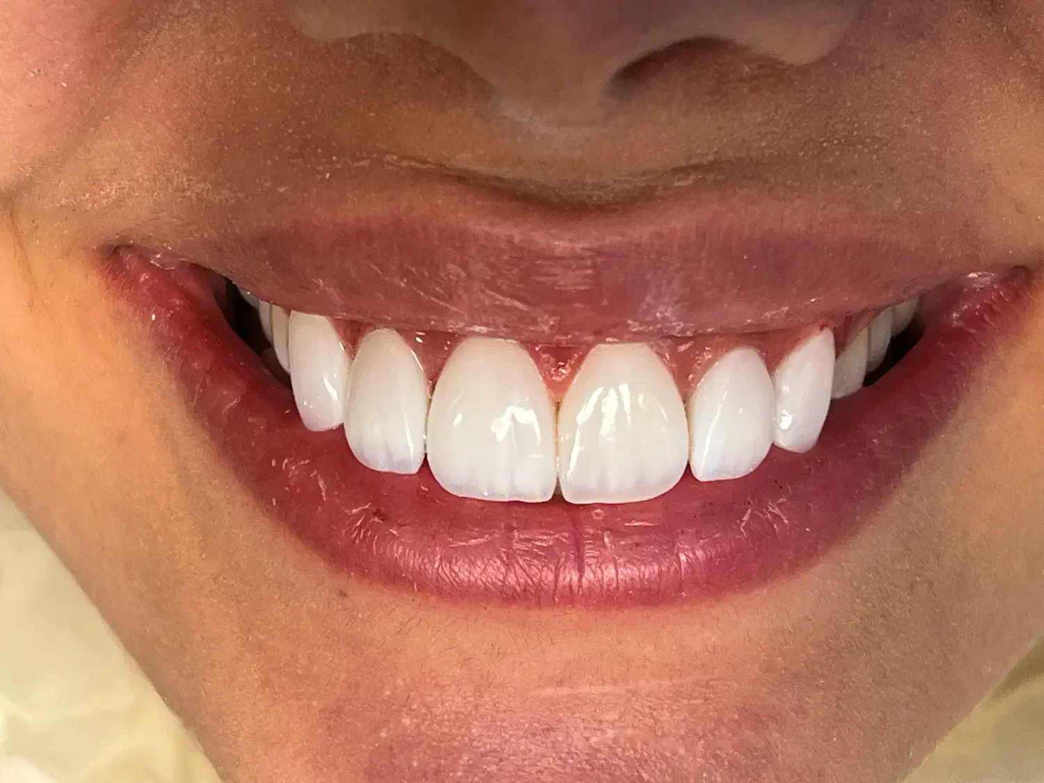 مدل ونیر کامپوزیت|خدمات آرایشگری و زیبایی|رشت, اسماعیل آباد|دیوار