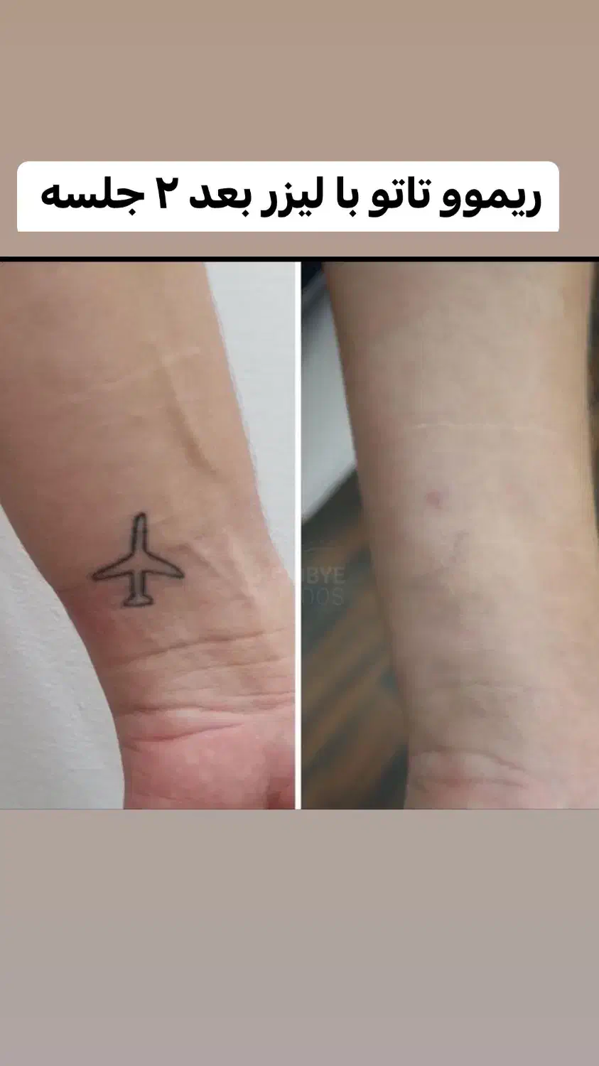 ریموو تاتو صورت و بدن با لیزر کیوسوییچ امریکایی|خدمات آرایشگری و زیبایی|گرگان, |دیوار