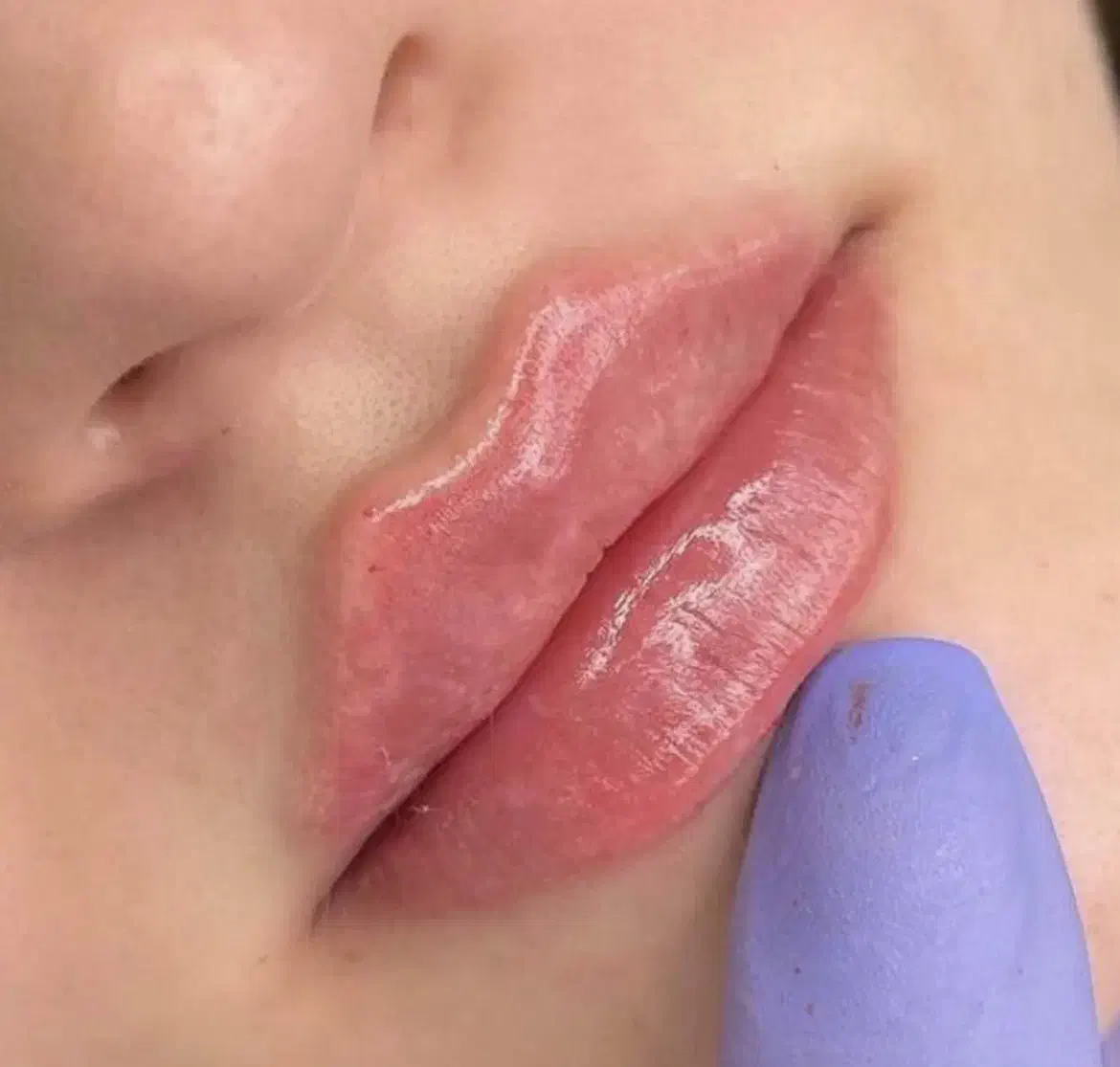 اف تزریق ژل روسی،عربی،خلیجی، بوتاکس|خدمات آرایشگری و زیبایی|شیراز, شهرک امیر کبیر|دیوار