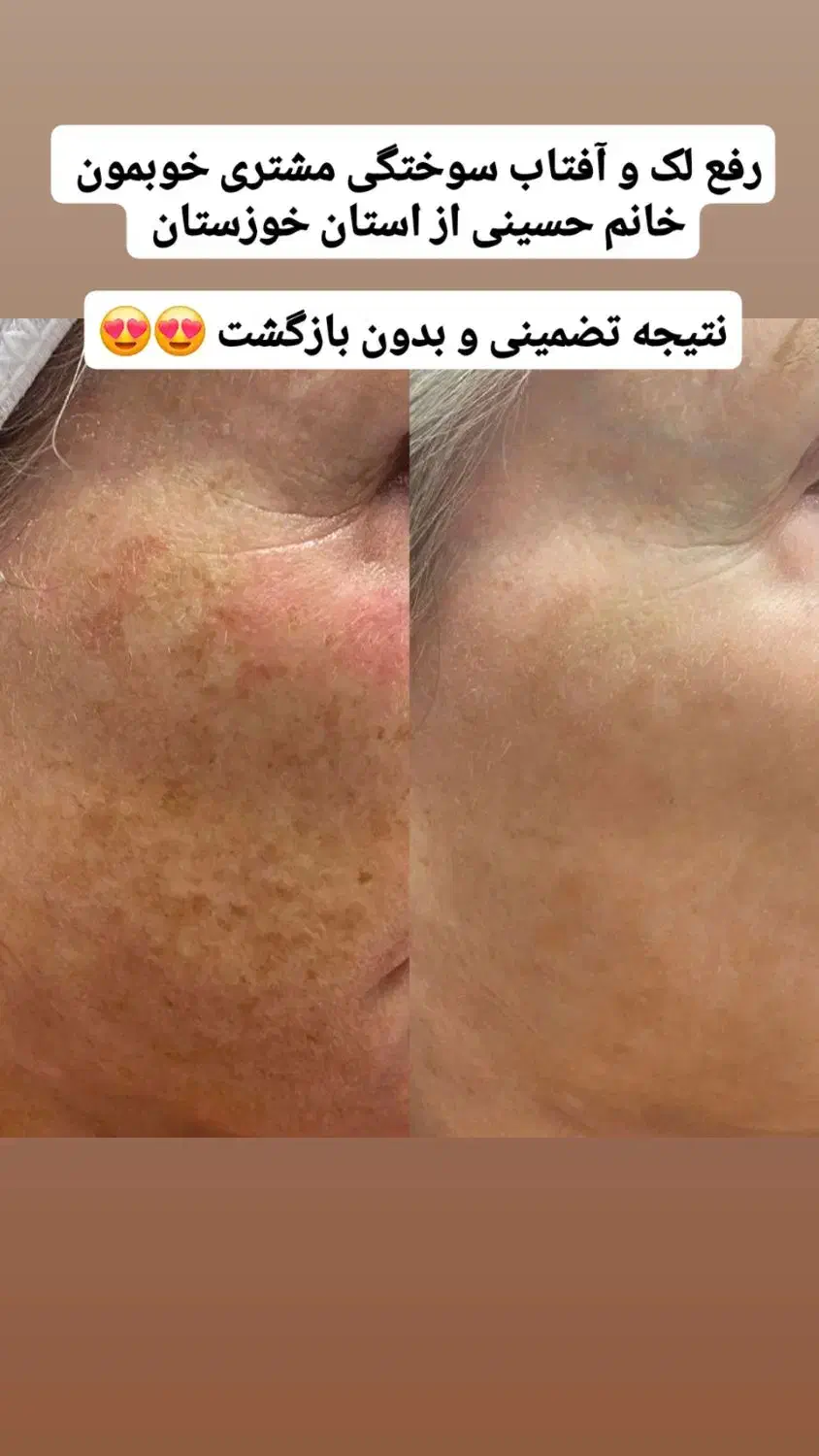 قویترین ضد لک در ایران|آرایشی، بهداشتی، درمانی|بوشهر, |دیوار
