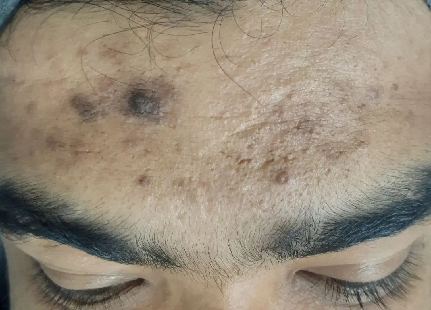 جای جوش و ابله و لک جوش|خدمات آرایشگری و زیبایی|دورود, |دیوار