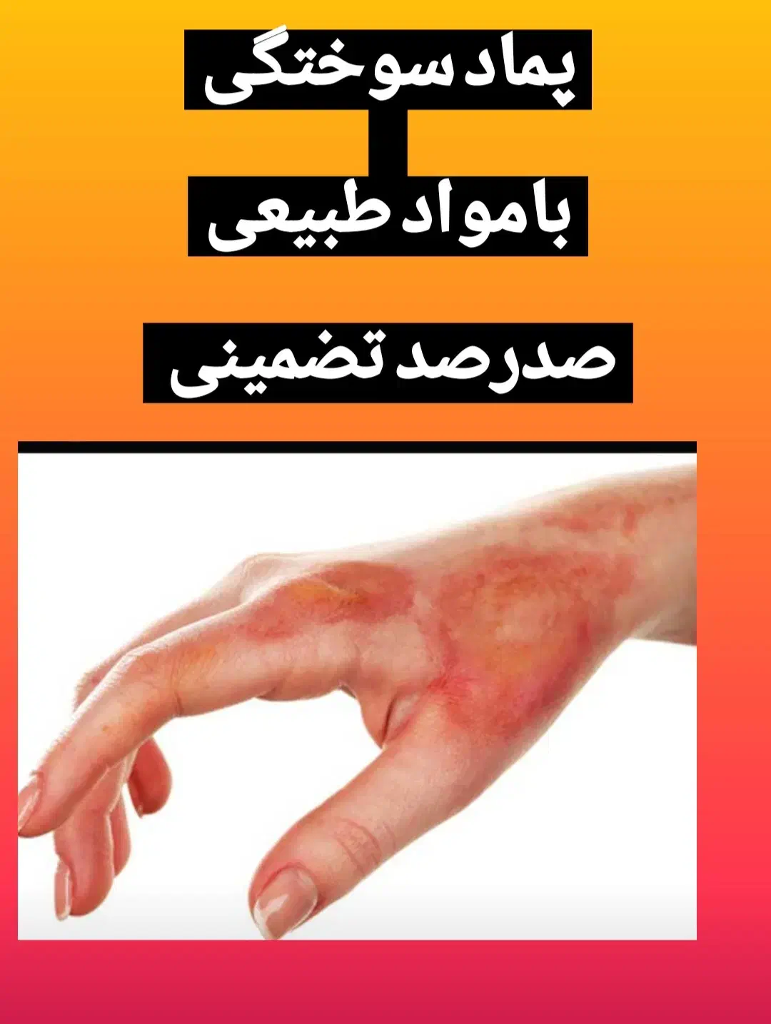 پماد سوختگی|آرایشی، بهداشتی، درمانی|تیکمه داش, |دیوار