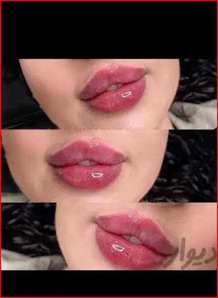 لیزر مو زائد، فشیال،پی آر پی،ژل و بوتاکس توسط پزشک|خدمات آرایشگری و زیبایی|مراغه, |دیوار