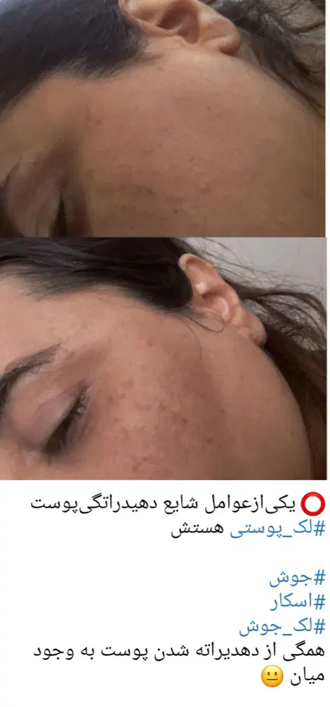 پاکسازی تخصصی پوست با دستگاه|خدمات آرایشگری و زیبایی|لاهیجان, امیرشهید|دیوار