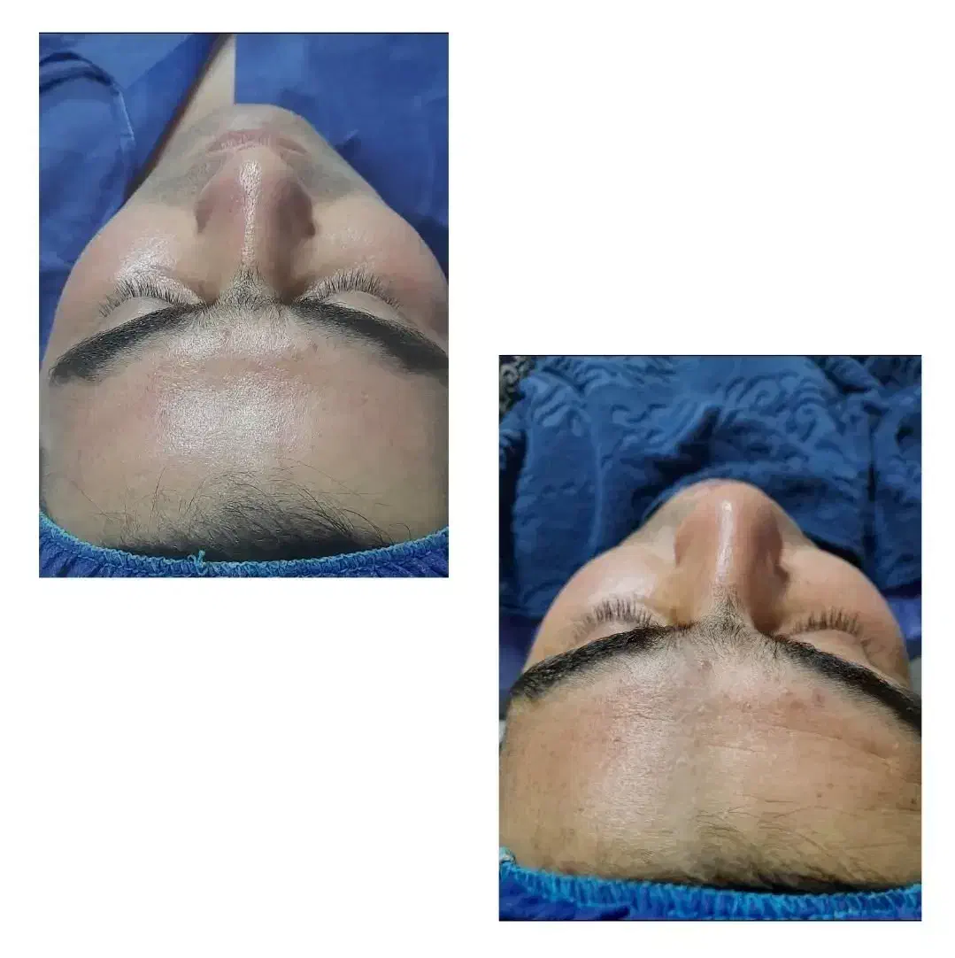 آموزش فیشال و پاکسازی پوست ویژه سال جدید|خدمات آموزشی|خوی, |دیوار