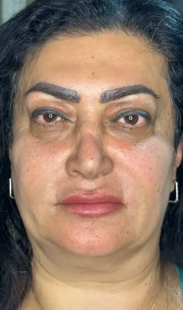 جشنواره اندولیفت تخصصی صورت وگردن|خدمات آرایشگری و زیبایی|تهران, جماران (نیاوران)|دیوار