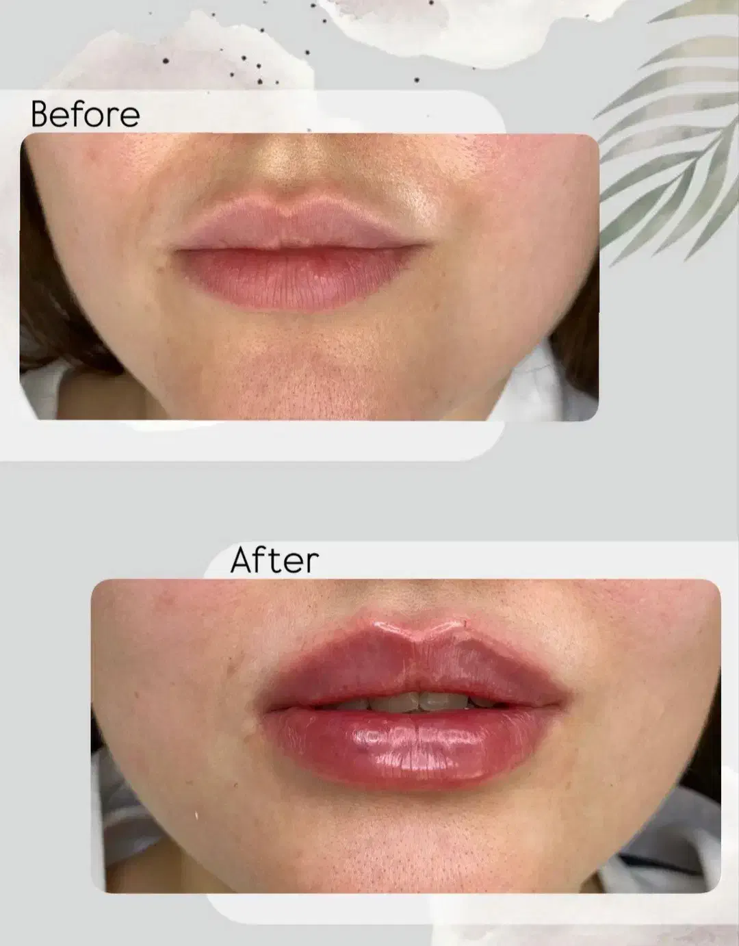 مدل تزریقات زیبایی|خدمات آرایشگری و زیبایی|تهران, محمودیه|دیوار