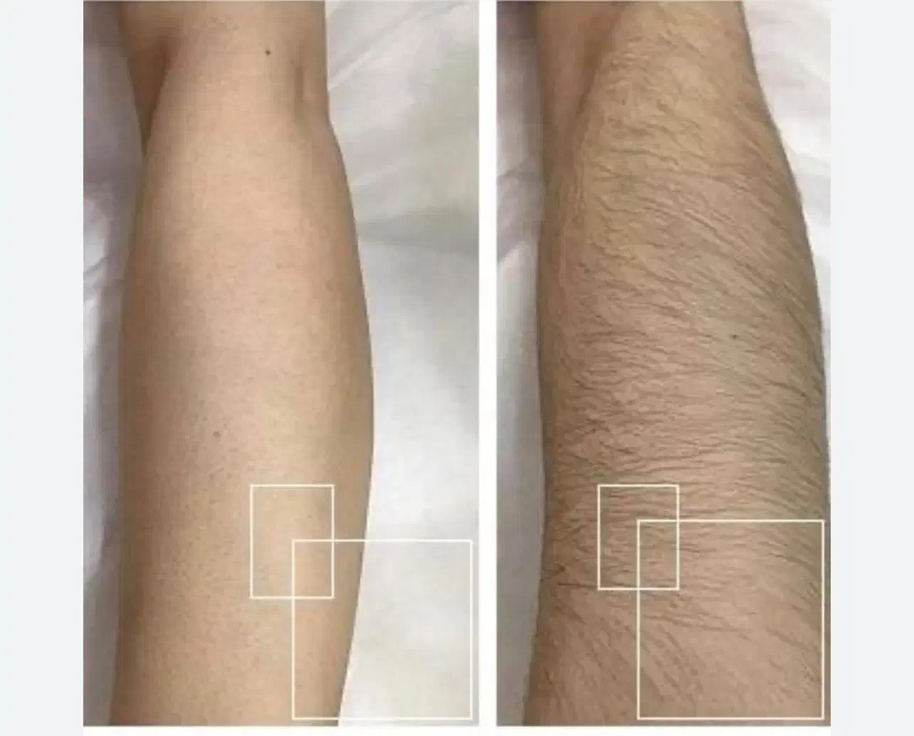 جشنواره لیزر حذف موهای زائد فول ۴۵۰|خدمات آرایشگری و زیبایی|ارومیه, |دیوار