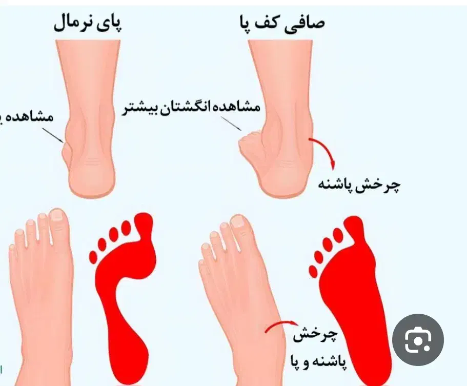 کلینیک تخصصی بهبود کف پای صاف|خدمات آرایشگری و زیبایی|رزن, |دیوار